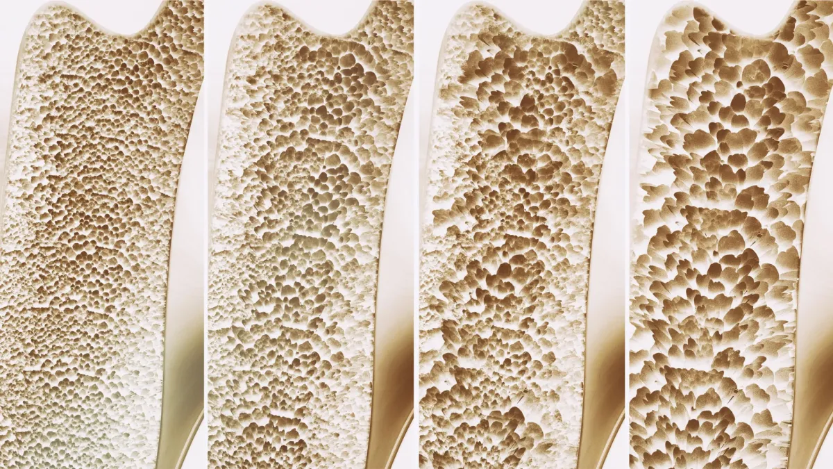 Bone-Building Switch Found: New Hope for Osteoporosis Treatment